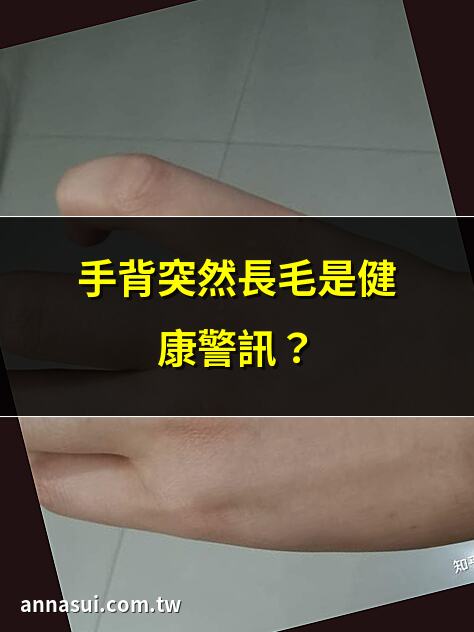 手背突然長毛是健康警訊？ | 手背長毛反映甚麼健康問題？ | 手背突然長毛正常嗎？ | 手背長毛看穿你的健康狀況