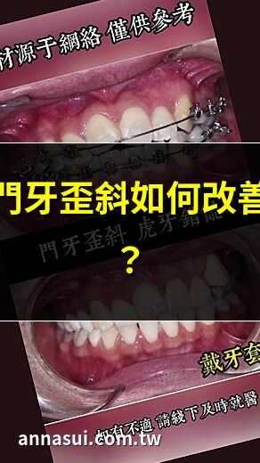 門牙歪斜